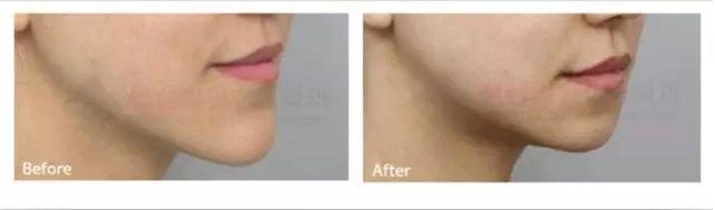 長下巴截骨—韓國灰姑娘醫(yī)院長下巴案例