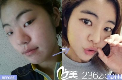 菏澤華美雙眼皮優(yōu)惠特價只需880元