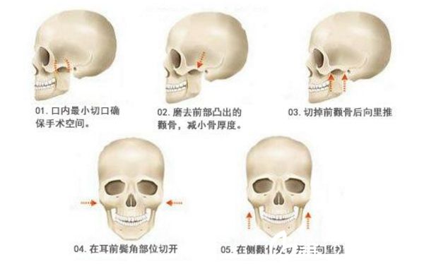 顴骨整形 顴骨降低