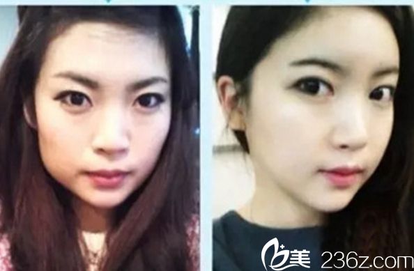 做顴骨整形哪家醫(yī)院好？北京做顴骨整形好的醫(yī)院