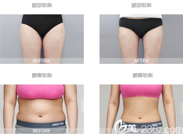 潘紅偉吸脂案例對(duì)比圖