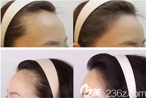 韓國毛杰琳發(fā)際線