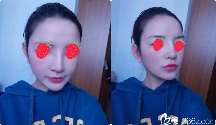 看南京維多利亞射極峰隆鼻案例剛拆完線就不腫了，你還選國(guó)產(chǎn)假體嗎