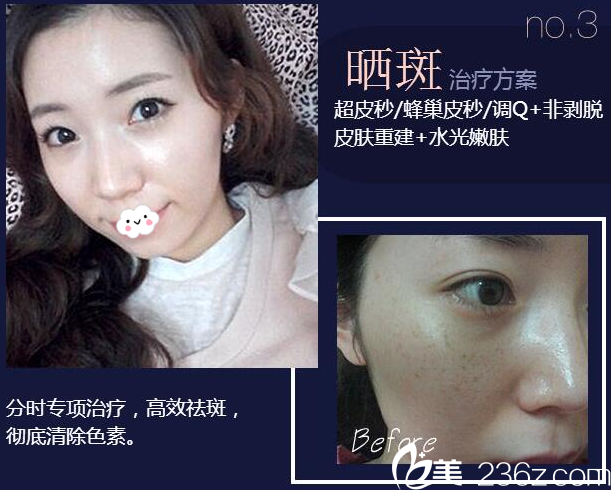 廣州華美整形醫(yī)院易陽亮?xí)癜咧委煱咐? alt=