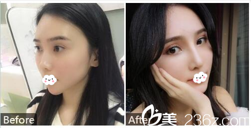 廣州紫馨2019新年優(yōu)惠整形價(jià)格表 李政祐雙眼皮4800元,姬付康隆鼻8800元附案例