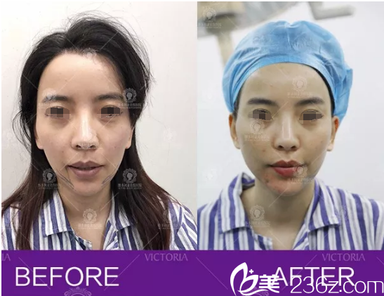 皮膚松垮、顯老的上班族媽媽找南京維多利亞金頌良院長(zhǎng)做線雕提升即刻對(duì)比照