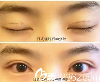 信陽金霞真人展示日式埋線雙眼皮手術(shù)過程 術(shù)后眼睛好看不止一點(diǎn)點(diǎn)