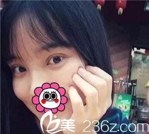 術(shù)后一周雙眼皮恢復(fù)中 術(shù)后一周雙眼皮恢復(fù)中