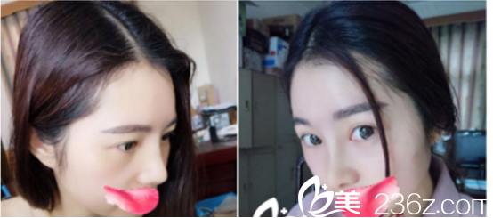 術后第20天基本已經不腫了