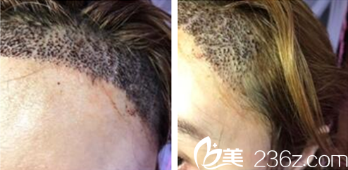 貴陽美貝爾發(fā)際線種植術后9天