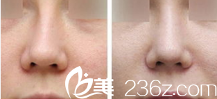 韓國(guó)Prima整形外科醫(yī)院郭赫俊歪鼻矯正效果 韓國(guó)Prima整形外科醫(yī)院郭赫俊歪鼻矯正效果