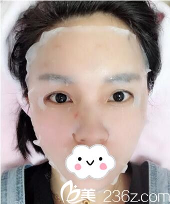 長沙美萊注射后敷面膜