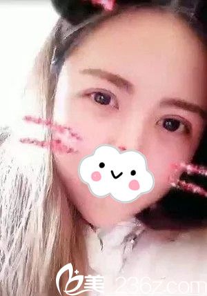 趁著出差在韓國摩茲整形讓千載玄院長給我做了雙眼皮手術(shù)，恢復(fù)的很自然