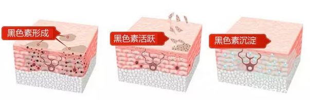 激光祛黑眼圈原理