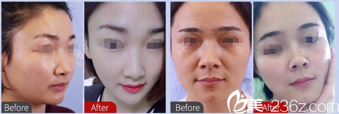 面部埋線提升前后對比案例