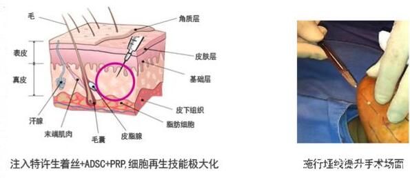 埋線提升有副作用嗎？