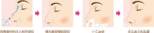 玻尿酸注射隆鼻流程