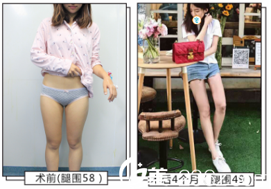 成都艾米麗大腿吸脂術(shù)后4個(gè)月對(duì)比 成都艾米麗大腿吸脂術(shù)后4個(gè)月對(duì)比