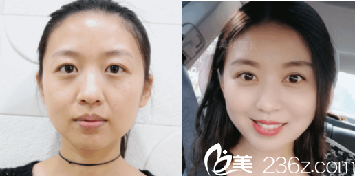 術(shù)前術(shù)后對比照片