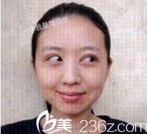 眼睛為什么還是這么的腫，我好慌啊