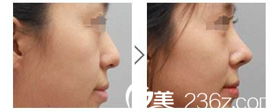 廉鋒隆鼻案例 廉鋒隆鼻案例