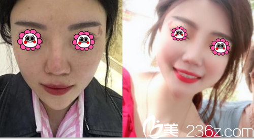 昆明美伊萊鼻修復(fù)案例