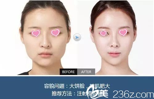 袁抒懷醫(yī)生微整手術(shù)真人案例展示