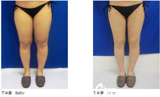 廣島美容外科醫(yī)院吸脂手術(shù)