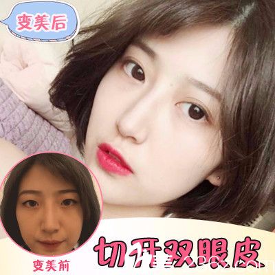 汕頭名流圣誕節(jié)優(yōu)惠整形價(jià)格表 雙眼皮1280元,隆鼻3980元,線雕6800元