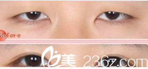 眼睛大小不一致修復(fù)案例