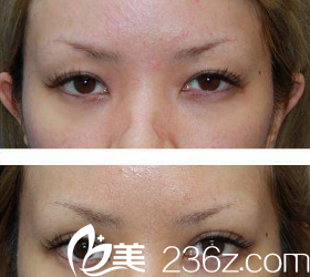 眼部寬窄修復(fù)案例