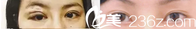 眼部疤痕修復(fù)案例