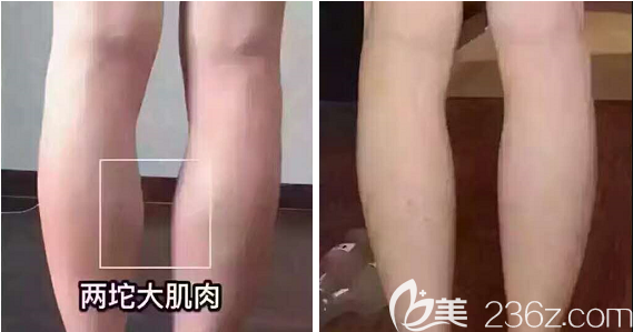 成都美容整形醫(yī)院瘦腿術(shù)后效果 成都美容整形醫(yī)院瘦腿術(shù)后效果