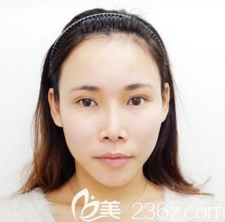 日本十仁做假體隆鼻加耳軟骨墊鼻尖術(shù)后一個(gè)月