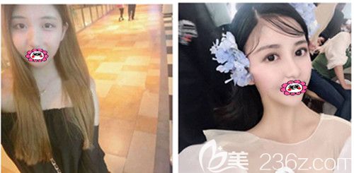 符恒雙眼皮前后效果圖