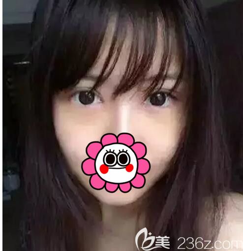 雙眼皮+開眼角+去皮去脂，你們想要的眼綜合術(shù)后蛻變效果是常熟時代這樣的嗎