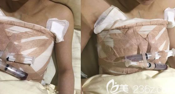 溫州藝星醫(yī)院剛做完隆胸的照片