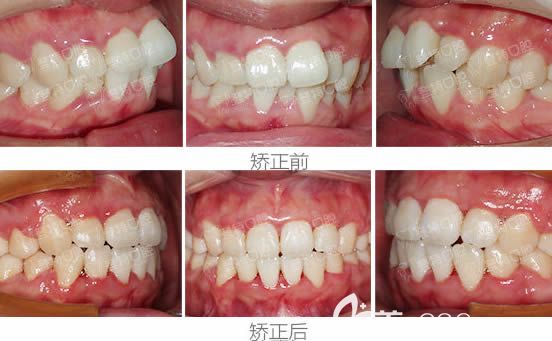 骨性齙牙兼牙列不齊在廈門登特口腔矯正兩年后，使30歲的我側(cè)臉逆襲