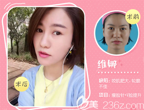 遵義韓美打瘦臉效果怎么樣