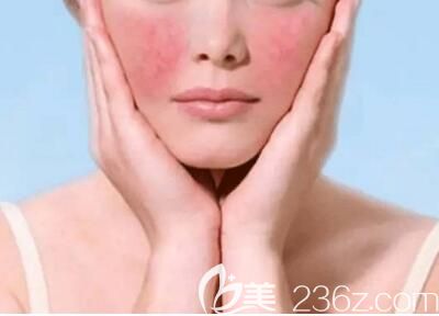 激光去紅血絲多少錢？激光去紅血絲的原理