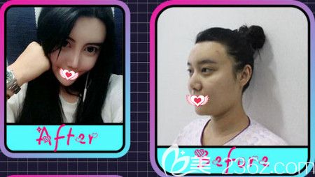 邯鄲華美4月整形又降價 硅膠隆鼻和微針美塑優(yōu)惠活動價為3080元