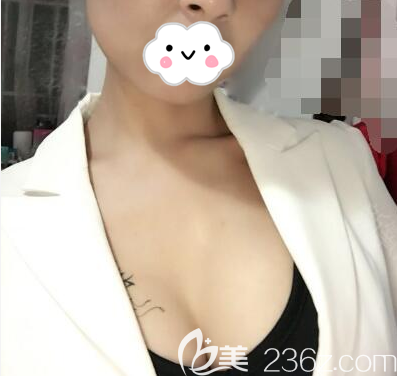 潘紅偉假體豐胸術(shù)后2個月照片