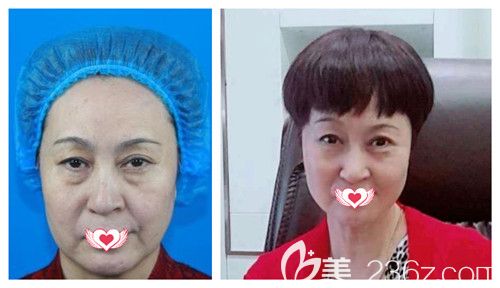 天伊美整形醫(yī)院做埋線提升案例