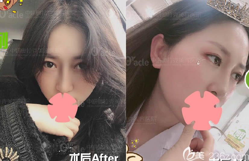 和閨蜜同時在長春中妍奧拉克做的鼻綜合隆鼻，大家看看我倆誰的效果更好呢