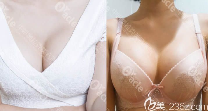 在長春中妍奧拉克吸脂瘦大腿后，再用自體脂肪豐胸一舉兩得！