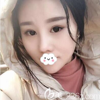 我要是早早在成都銅雀臺(tái)找劉祎做了肋軟骨鼻綜合手術(shù)，就不去嘗試那種隆鼻神器了，沒(méi)用不說(shuō)還很疼