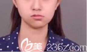 青島做下顎矯正手術(shù)術(shù)前照片