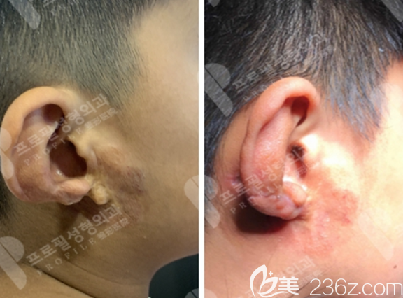 孩子耳朵萎縮8年了韓國(guó)普羅菲耳鄭在皓耳朵再造讓兒子終于有了耳朵