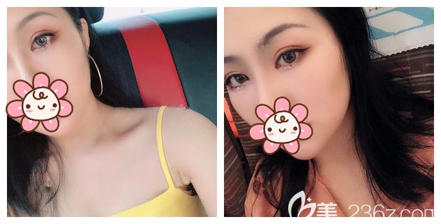 做完切開雙眼皮半年眼睛還是腫腫的 咨詢對比多家后到南京華韓奇致做了眼部修復術(shù)后27天不見失敗痕跡