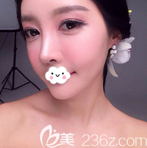 找韓國(guó)普羅菲耳（profile）整形醫(yī)院李好基做了鼻綜合和假體豐下巴，好多人都說自然好看